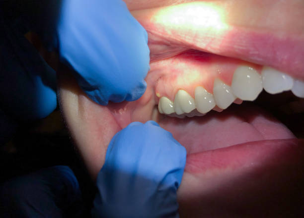Best Emergency Dentist for Lost Fillings or Crowns in Norman, OK